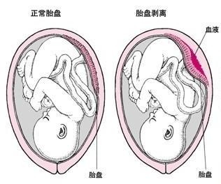 三个月胎盘低置，应对策略与建议