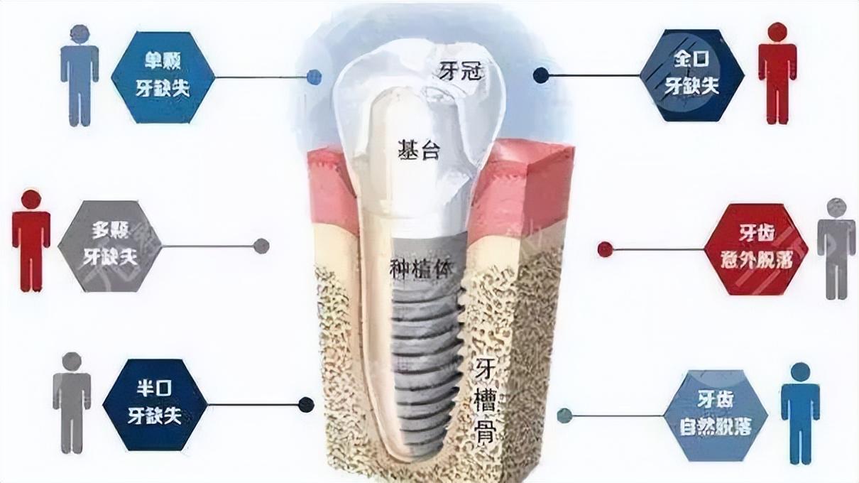 最新种牙技术，重塑笑容的神奇力量